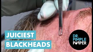 Juicy Blackheads Extracted by Dr Pimple Popper [upl. by Eselahs]