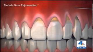 Reverse Receding Gums  Pinhole Gum Rejuvenation [upl. by Bittencourt]