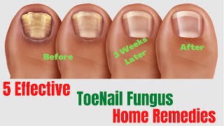 5 Natural Remedies For Toenail Fungus – Toenail Fungus Treatment At Home [upl. by Otit]