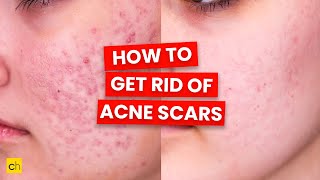 How To Get Rid of Acne Scars  Credihealth [upl. by Oruasi]