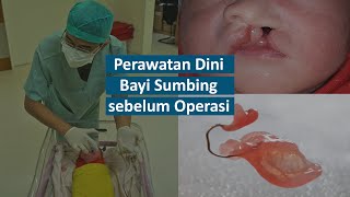 Bibir Sumbing Bayi baru lahir  butuh perawatan dini Dokter Bedah Mulut Semarang Drg Frans Praba [upl. by Eidualc]