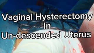 Vaginal Hysterectomy in Undescended uterus  Very important  Tips and Tricks  to make it Easy ⭐️⭐️ [upl. by Herb739]