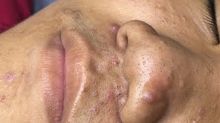 ACNE TREATMENT VU QUYNH MI Acne On Boys Nose 2024 [upl. by Devlin]