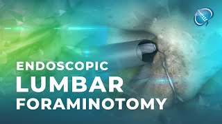 What is Endoscopic Lumbar Foraminotomy [upl. by Choong255]