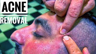 ASMR ACNE REMOVAL AND ASMR MASSAGE • Cleanliness and comfortable sleep • Sivilce Temizleme [upl. by Oinotnaesoj]