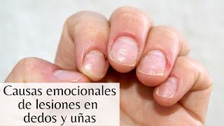 ¿Qué causa las lesiones en dedos y uñas [upl. by Nomolas]