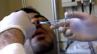 Nose Splint Removal in ED [upl. by Nady]