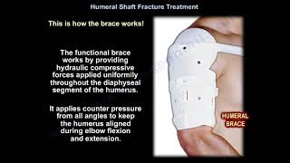 Humeral Shaft Fracture Treatment  Everything You Need To Know  Dr Nabil Ebraheim [upl. by Sahpec242]