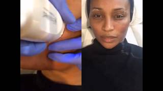 EndyMed RF Micro Needling with RHOAs Cynthia Bailey at Ederra Bella [upl. by Lissa]