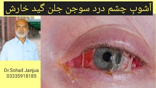 EYE INFECTION  VIRAL EYE FLUE  أشوبِ چشم  HOMOEO MEDICINE [upl. by Aveer]