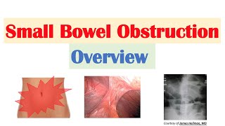 Small Bowel Obstruction SBO  Risk Factors Causes Signs amp Symptoms Diagnosis Treatment [upl. by Atteuqnas351]