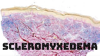 Scleromyxedema with colloidal iron stain pathology dermpath dermatology [upl. by Posehn104]