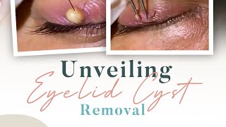 Unveiling Eyelid Cyst Removal [upl. by Meghan]