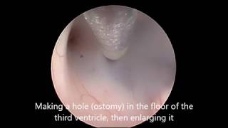 ETV and lysis of adhesion for hydrocephalus [upl. by Meehahs]