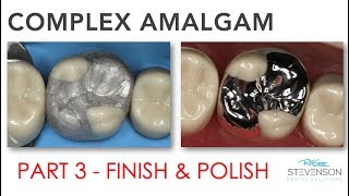 Complex Amalgam  Finishing amp Polishing  Part 3 [upl. by Yanffit]