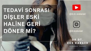 Ortodonti Tedavisi Sonrası Dişler Eski Haline Geri Döner Mi  Dr Dt Ece Karaer [upl. by Nylessoj]