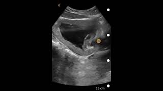 Bladder Debris Ultrasound Image Interpretation [upl. by Anelrihs]