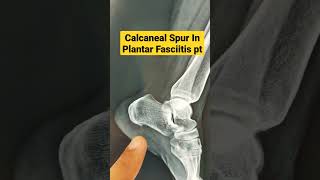 Calcaneal Spur In Plantar Fasciitis ptDr Sai Chandra [upl. by Kendal798]