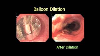 quotPrevention of Esophageal Stricture After Endoscopicquot [upl. by Nybbor]