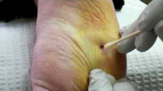 Surgical Plantar Wart Removal [upl. by Christen]