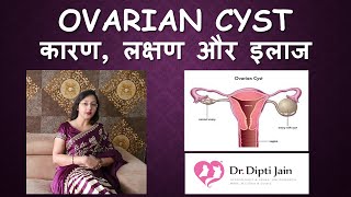 OVARIAN CYST ओवरी में गाँठ  सिस्ट HINDI Gynaecologist Dr Dipti Jain Ahmedabad [upl. by Pacifa367]