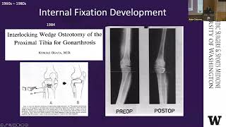 Osteotomy Past Present and Future [upl. by Chauncey]