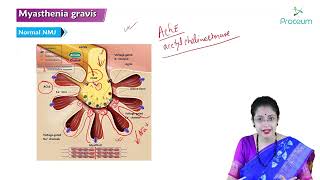 Myasthenia Gravis Part 1 Hindi  Internal Medicine [upl. by Nottap]