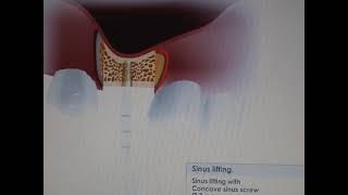 Sinus lift video using MISImplants Bone compression kit [upl. by Pacificas]