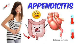 Appendicitis  The only video you will need [upl. by Pournaras]