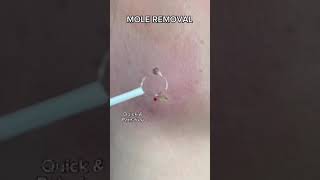 Mole Removal at Dr Medispa [upl. by Atrebla]