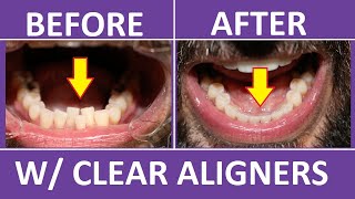 Invisalign Braces Before and After Overbite Crowding Teeth Cost Pain Tips 3M Clear Aligners [upl. by Kragh]