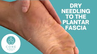 Dry Needling to the Plantar Fascia [upl. by Lark95]