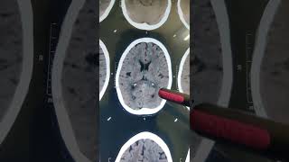 INTRACRANIAL CALCIFICATION doctor hospital  shorts video [upl. by Posner]