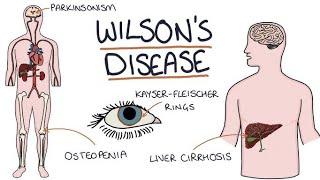 WILSON DISEASE GENETIC DISORDER OF LIVERBSC NURSINGdailypost [upl. by Llevert]