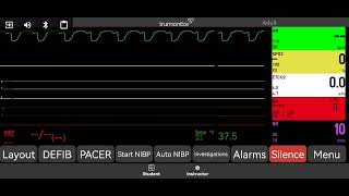 Pulseless Ventricular Tachycardia pVT [upl. by Wenoa99]