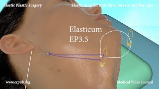 61 ELASTIC NECK LIFT WITHOUT DISSECTION [upl. by Esinert]