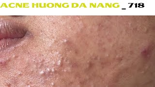 Acne Treatment Huong Da Nang 718  Remove Blackheads [upl. by Edora]