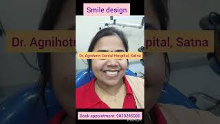 Smile design in midline diastemasmile makeover Zirconia dentist dentistry smilemakeover views [upl. by Ottilie]