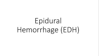 Epidural Hemorrhage  Extradural Hematoma EDH  General Surgery [upl. by Ekrub]