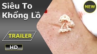 MỤN SIÊU TO KHỔNG LỒ TẠI HIỀN VÂN SPA [upl. by Hanah]