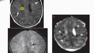 week7 pediatric neuroimaging [upl. by Boarer]