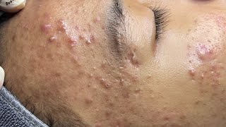 ACNE TREATMENT VU QUYNH MI  Perennial Blackheads On Boy Face 2024FULL [upl. by Kattie50]