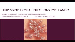 HERPES SIMPLEX VIRUS 1 amp 2 INFECTIONSeducation funny skincondition std skindisease [upl. by Kaslik]