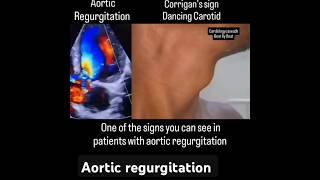 aortic regurgitation signsdancing carotid corrigans sign Sudarshanlipane17 ✨⛑️🏥🏥✨🏆🧪💉💉 [upl. by Assirem]