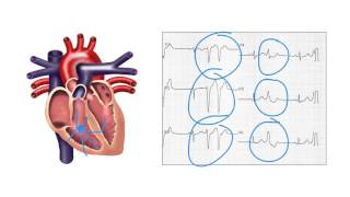 Determining the origin of ventricular ectopic beats on the ECG  Ask Andrew [upl. by Hellman]