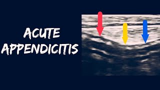 Acute appendicitis [upl. by Romona334]