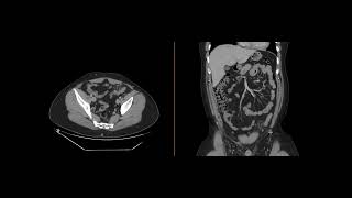 Epiploic Appendagitis [upl. by Halas]