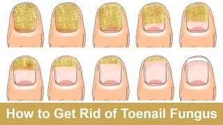 How to Get Rid of Toenail Fungus Fast and Naturally [upl. by Leinad]