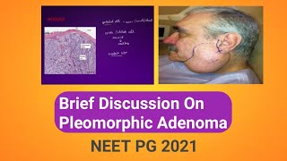 Brief Discussion On Pleomorphic Adenoma  General Surgery  NEET PG 2021 [upl. by Kneeland873]