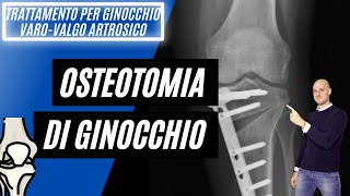 Osteotomia per ginocchio artrosico [upl. by Drewett]